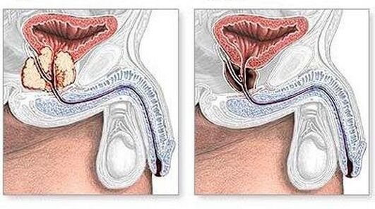 Antes y después del tratamiento de la prostatitis crónica quirúrgicamente