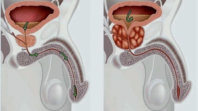 próstata sana e inflamada con prostatitis