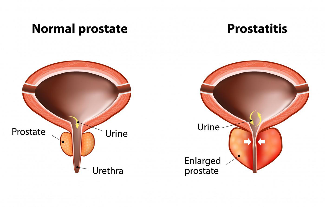Próstata normal de un hombre sano e inflamación de la próstata con prostatitis.