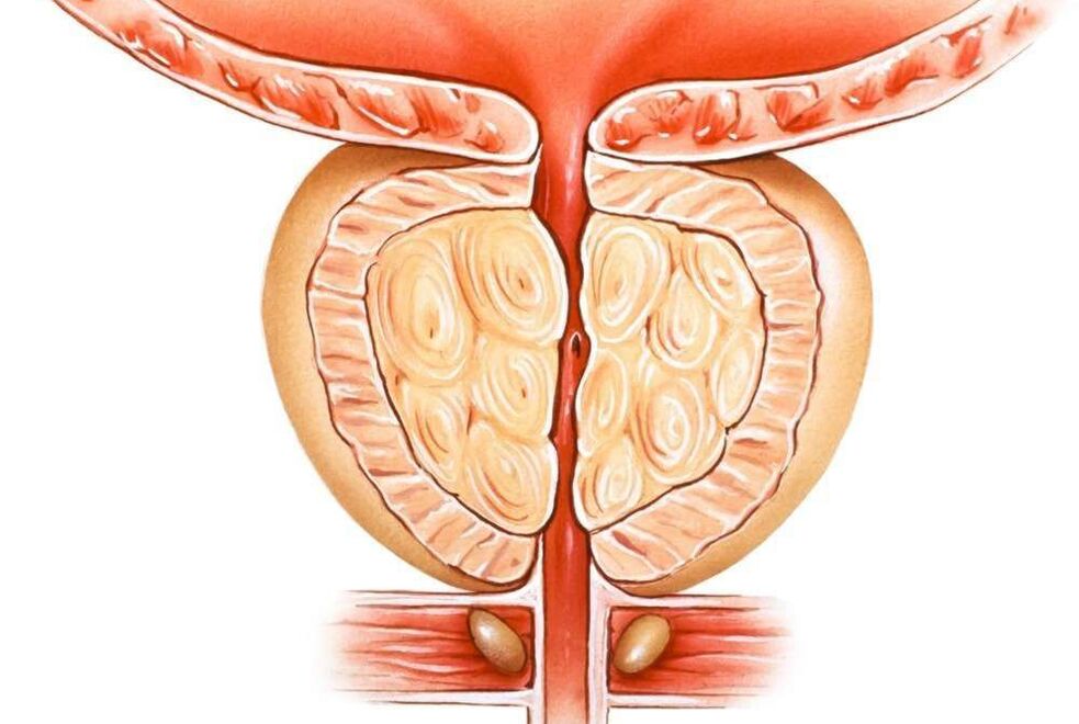 prostatitis congestiva