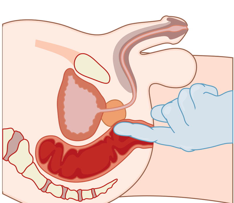 masaje de próstata con prostatitis